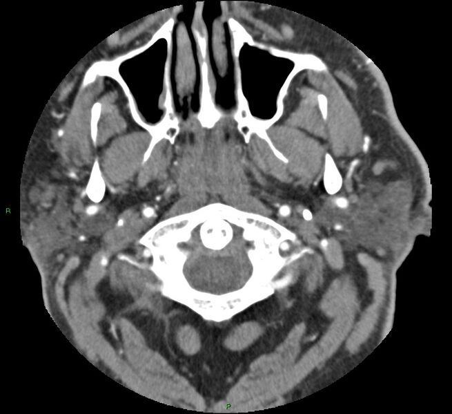 File:Brainstem hemorrhage (Radiopaedia 58794-66028 D 4).jpg
