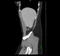 Broad ligament hernia (Radiopaedia 63260-71832 C 8).jpg
