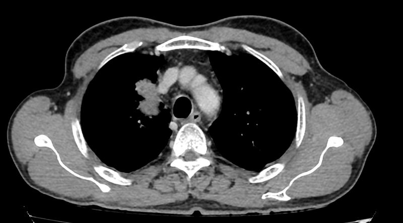 File:Bronchogenic carcinoma with superior vena cava syndrome (Radiopaedia 36497-38054 Axial C+ delayed 22).jpg