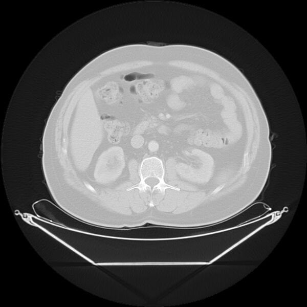 File:Bronchogenic carcinoma with upper lobe collapse (Radiopaedia 29297-29726 Axial lung window 38).jpg