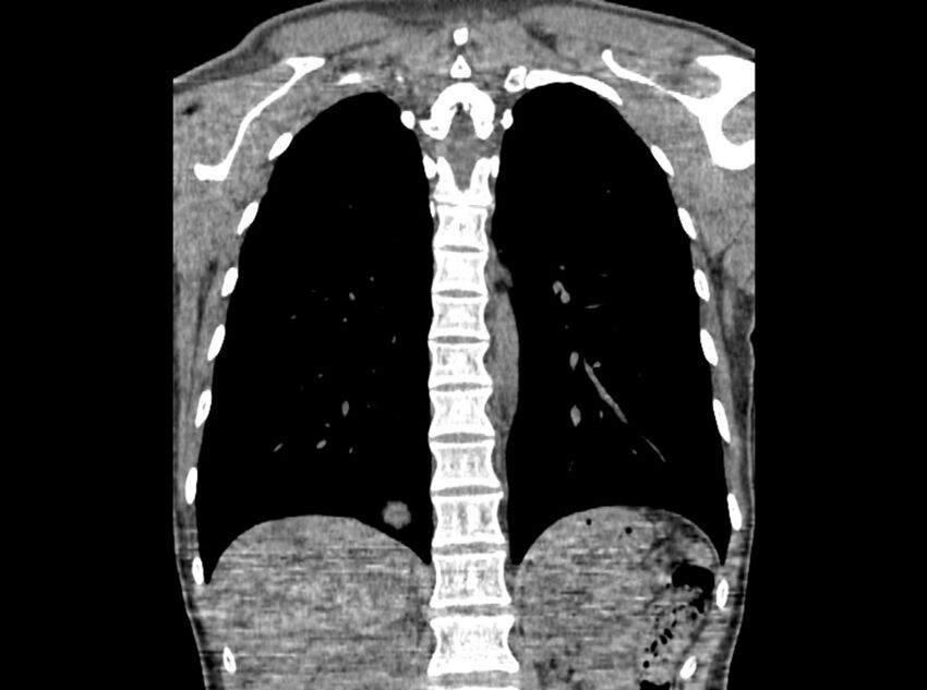 Bronchogenic cyst (Radiopaedia 80273-93615 D 77).jpg