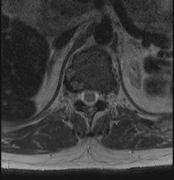 File:Brown tumors compressing the spinal cord (Radiopaedia 68442-78030 A 2).jpg