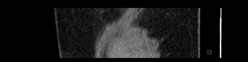 Buried bumper syndrome - gastrostomy tube (Radiopaedia 63843-72575 Sagittal Inject 4).jpg