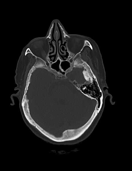 File:Burnt-out meningioma (Radiopaedia 51557-57337 Axial bone window 14).jpg