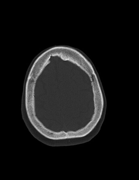 File:Burnt-out meningioma (Radiopaedia 51557-57337 Axial bone window 41).jpg