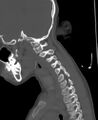 Butterfly vertebra (Radiopaedia 77903-90209 Sagittal bone window 73).jpg