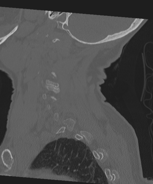 File:C2 fracture with vertebral artery dissection (Radiopaedia 37378-39199 Sagittal bone window 20).png