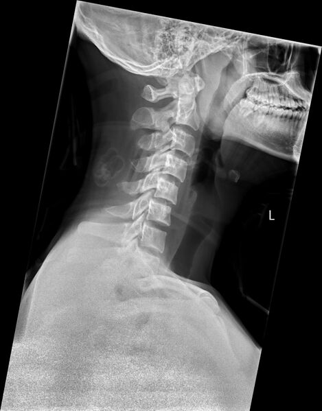 File:C5 facet fracture (Radiopaedia 58374-65500 Lateral 1).jpg