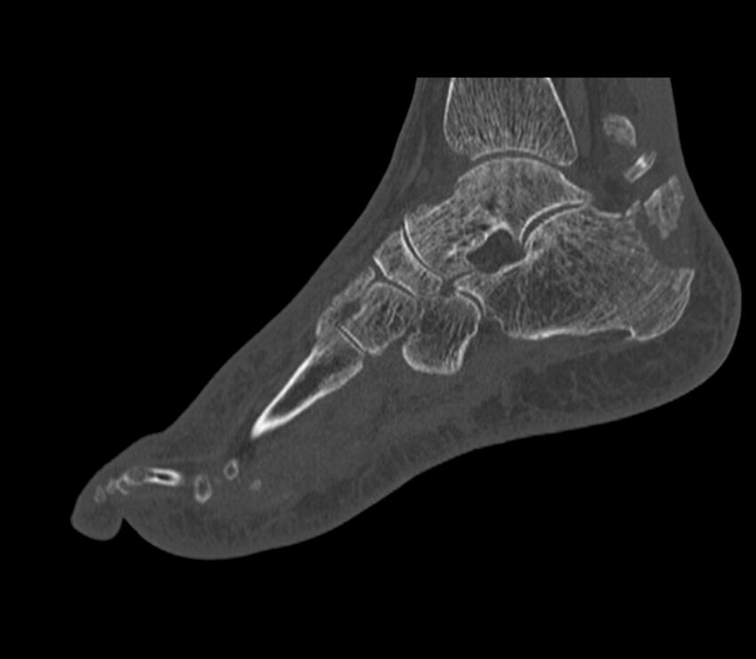 Calcaneal tuberosity avulsion fracture (Radiopaedia 22649-22668 Sagittal bone window 23).jpg