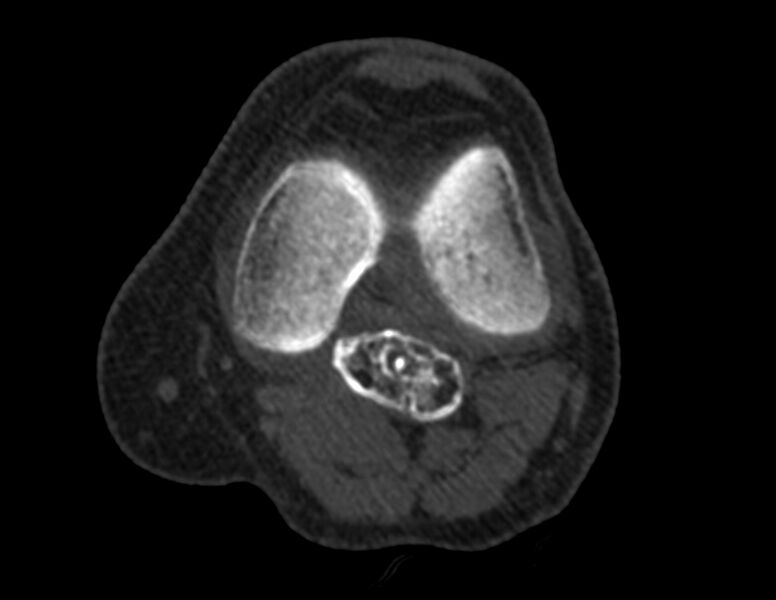 File:Calcified hematoma - popliteal fossa (Radiopaedia 63938-72763 Axial bone window 15).jpg