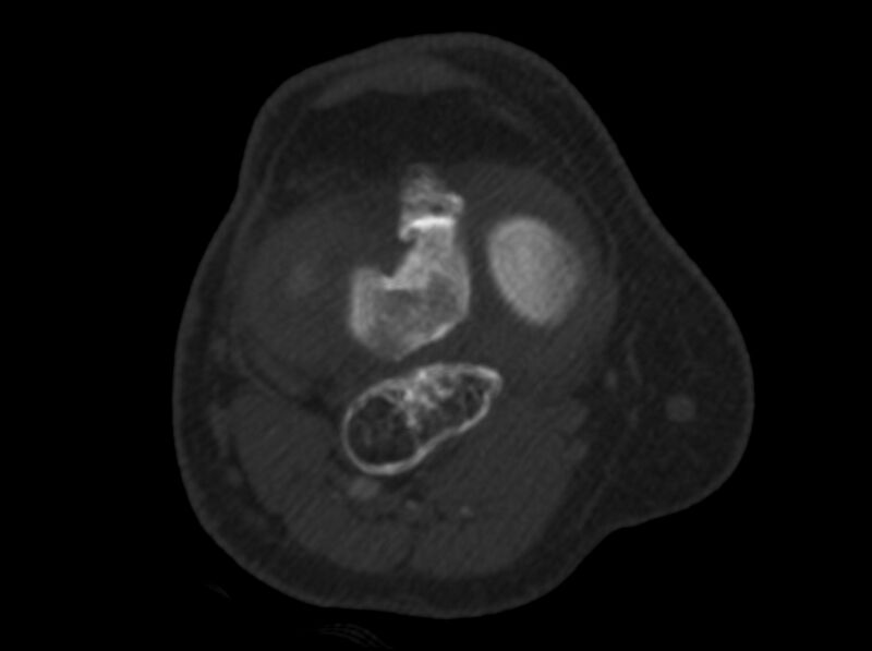 File:Calcified hematoma - popliteal fossa (Radiopaedia 63938-72763 C 24).jpg