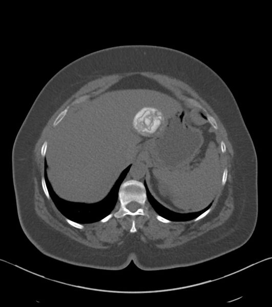 File:Calcified hepatic hydatid cyst (Radiopaedia 81127-94738 Axial non-contrast 19).jpg