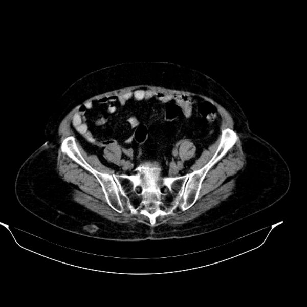 File:Calcified hydatid cyst (Radiopaedia 62000-70085 Axial non-contrast 84).jpg