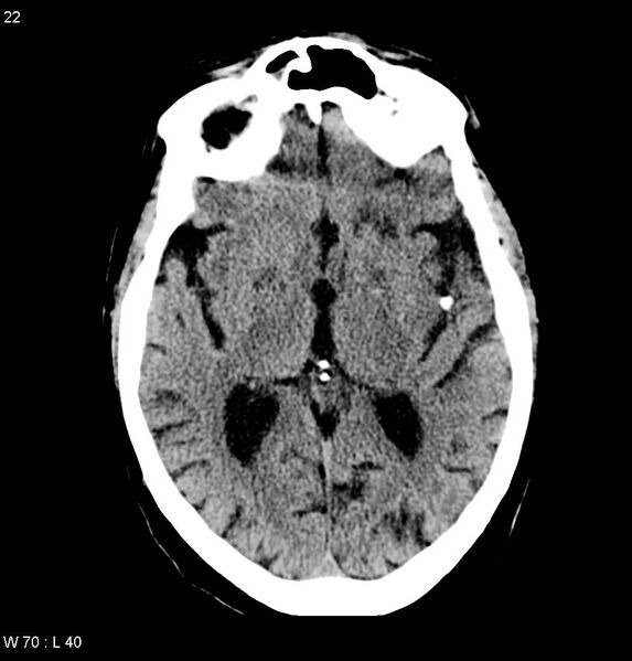 File:Calcified left middle cerebral artery embolism (Radiopaedia 5570-22120 Axial non-contrast 5).jpg
