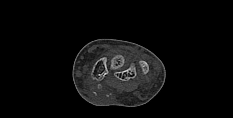 File:Calcifying aponeurotic fibroma (Radiopaedia 88423-105064 Axial bone window 63).jpg