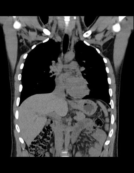 File:Calcifying pulmonary metastases (Radiopaedia 33359-34396 Coronal non-contrast 27).jpg