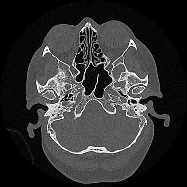 File:Canal up mastoidectomy (Radiopaedia 78108-90638 Axial bone window 45).jpg