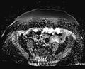 Cancer cervix - stage IIb (Radiopaedia 75411-86615 Axial ADC 29).jpg