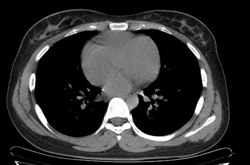 File:Cannonball metastases - uterine choriocarcinoma (Radiopaedia 70137-80173 Axial non-contrast 72).jpg