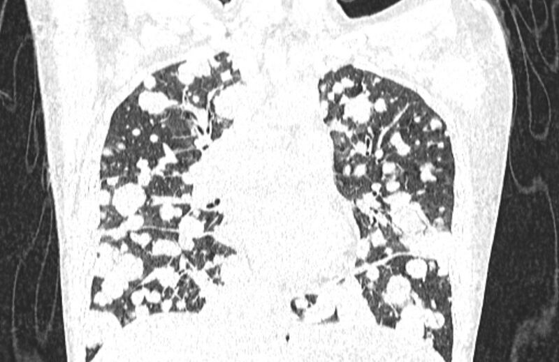 File:Cannonball metastases from breast cancer (Radiopaedia 91024-108569 Coronal lung window 68).jpg