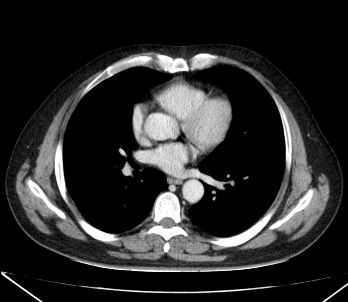 File:Carcinoid tumor with hepatic metastases (Radiopaedia 22651-22670 C 19).jpg