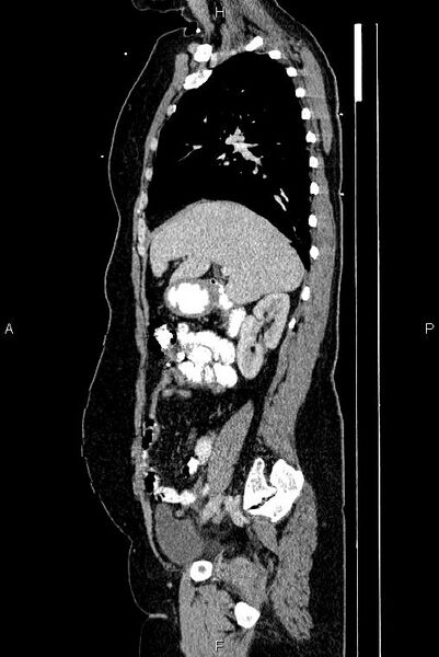 File:Carcinoma of uterine cervix (Radiopaedia 85861-101700 D 25).jpg