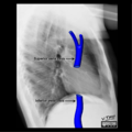 Cardiomediastinal anatomy on chest radiography (annotated images) (Radiopaedia 46331-50748 B 1).png