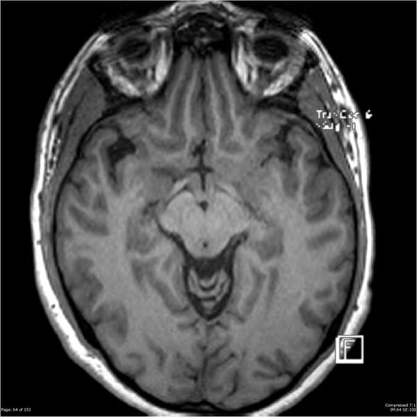 File:Cavernous malformation (cavernous angioma or cavernoma) (Radiopaedia 36675-38237 Axial T1 53).jpg
