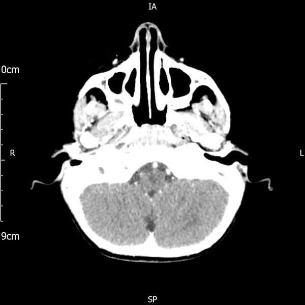 File:Cavernous sinus thrombosis (Radiopaedia 79414-92510 Axial Brain 57).jpg