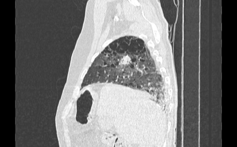 File:Cavitating bronchogenic carcinoma (Radiopaedia 44489-48162 Sagittal lung window 7).jpg