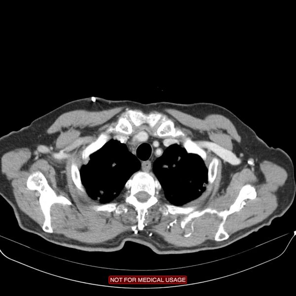 File:Cavitating pulmonary metastases (Radiopaedia 24920-25184 B 1).jpg
