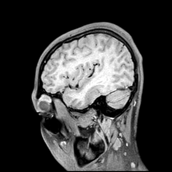 File:Central neurocytoma (Radiopaedia 79320-92380 Sagittal T1 63).jpg
