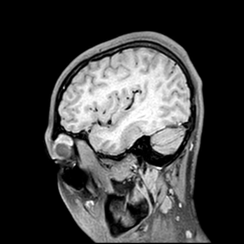 Central neurocytoma (Radiopaedia 79320-92380 Sagittal T1 63).jpg