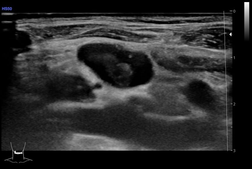 Central venous catheter-related thrombosis (Radiopaedia 61135-69025 Transverse 30).jpg