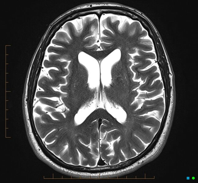 File:Cerebellar gangliocytoma (Radiopaedia 65377-74422 Axial T2 22).jpg
