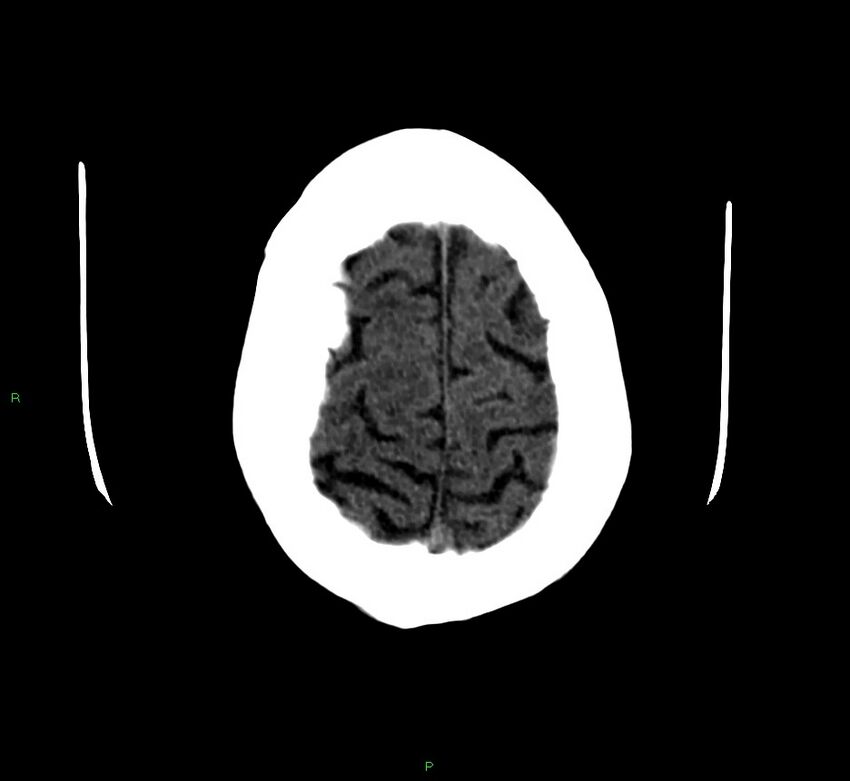 Cerebellar hemorrhage (Radiopaedia 58792-66026 Axial non-contrast 8).jpg