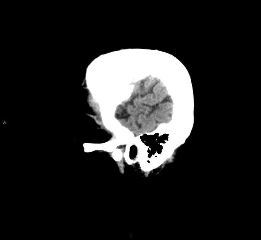 Cerebral amyloid angiopathy-associated lobar intracerebral hemorrhage (Radiopaedia 58376-65511 C 6).jpg