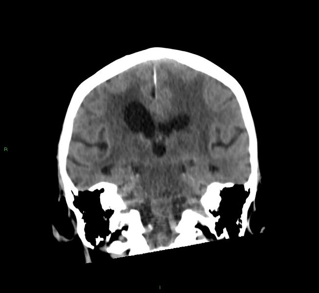 File:Cerebral amyloid angiopathy-associated lobar intracerebral hemorrhage (Radiopaedia 58530-65688 Coronal non-contrast 31).jpg