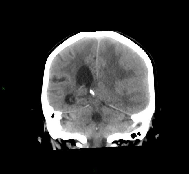 File:Cerebral amyloid angiopathy-associated lobar intracerebral hemorrhage (Radiopaedia 58561-65724 Coronal non-contrast 25).jpg