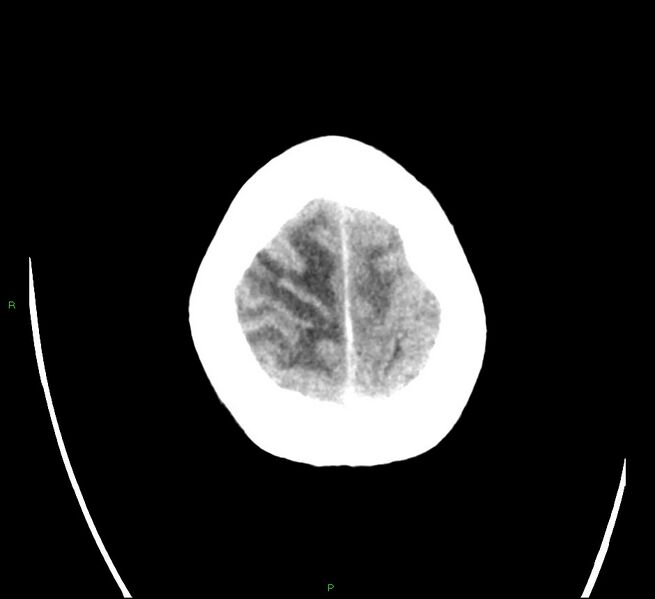 File:Cerebral amyloid angiopathy-associated lobar intracerebral hemorrhage (Radiopaedia 58566-65731 Axial non-contrast 24).jpg
