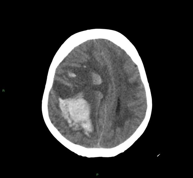 File:Cerebral amyloid angiopathy-associated lobar intracerebral hemorrhage (Radiopaedia 58751-65972 Axial non-contrast 19).jpg