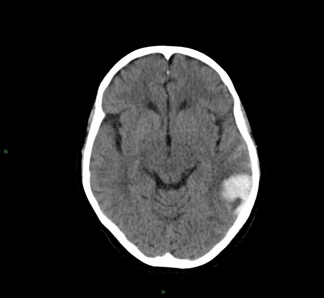 File:Cerebral amyloid angiopathy-associated lobar intracerebral hemorrhage (Radiopaedia 58757-65978 Axial non-contrast 31).jpg