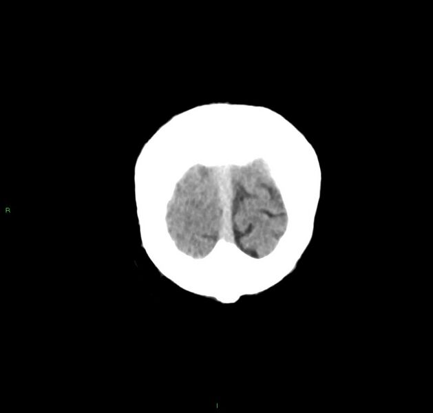 File:Cerebral amyloid angiopathy-associated lobar intracerebral hemorrhage (Radiopaedia 59356-66716 Coronal non-contrast 7).jpg