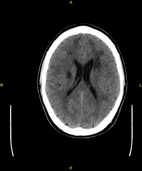 File:Cerebral autosomal dominant arteriopathy with subcortical infarcts and leukoencephalopathy (CADASIL) (Radiopaedia 86108-102051 Axial non-contrast 66).jpg