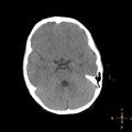 Cerebral contusion (Radiopaedia 48869-53911 Axial non-contrast 6).jpg