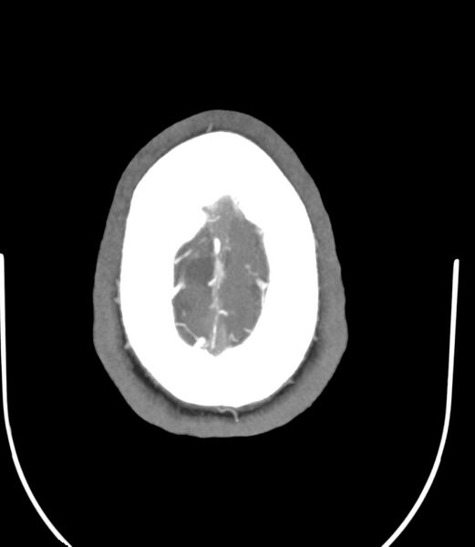 File:Cerebral dural venous sinus thrombosis (Radiopaedia 86514-102576 A 87).jpg