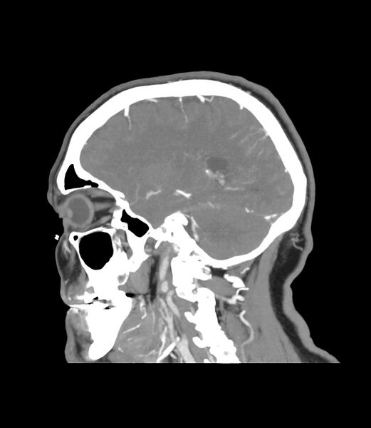 File:Cerebral dural venous sinus thrombosis (Radiopaedia 86514-102576 C 16).jpg