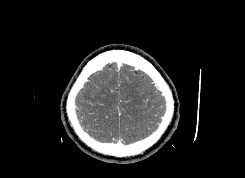 Cerebral edema (Radiopaedia 82519-96661 B 13).jpg