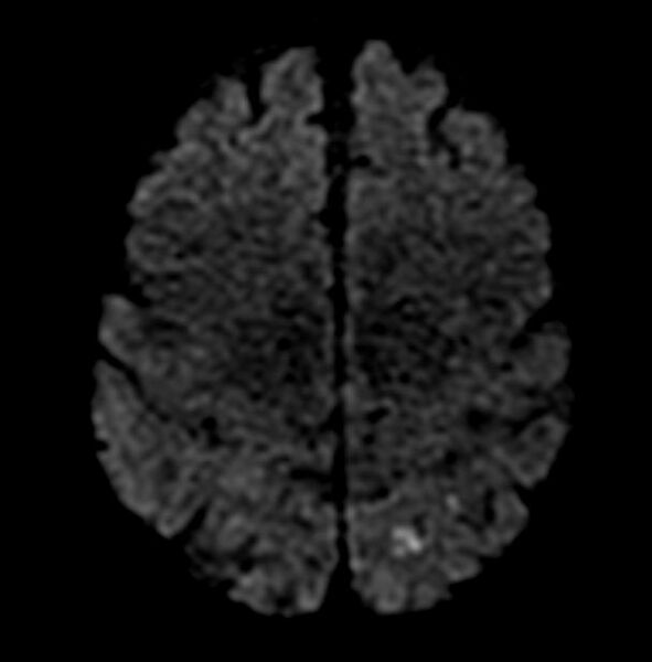 File:Cerebral embolic infarction (Radiopaedia 11288-11652 Axial 3).jpg