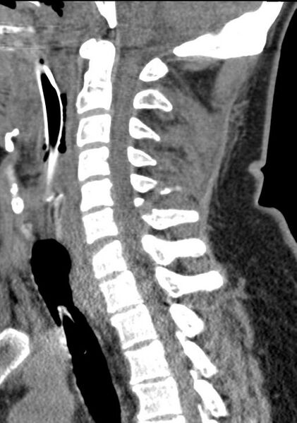 File:Cerebral hemorrhagic contusions and cervical spine fractures (Radiopaedia 32865-33841 G 60).jpg